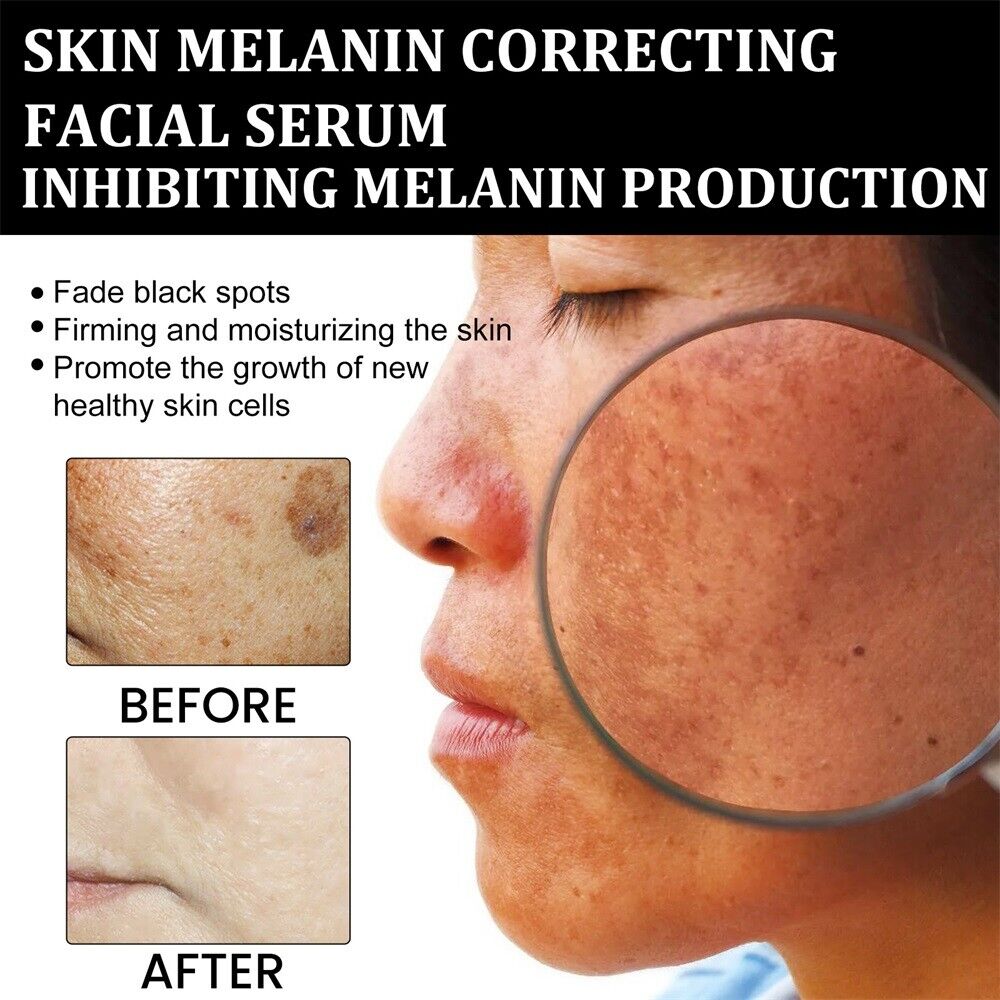 ✨Fast Dark Spot Remover-YIRANTIAN™ Melanin Correcting Facial Serum